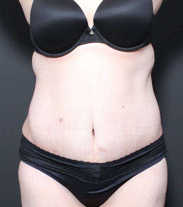Plus Size Tummy Tuck And Mommy Makeover